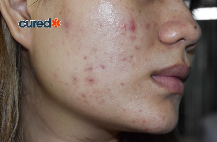 Cured Facts About Adult Acne