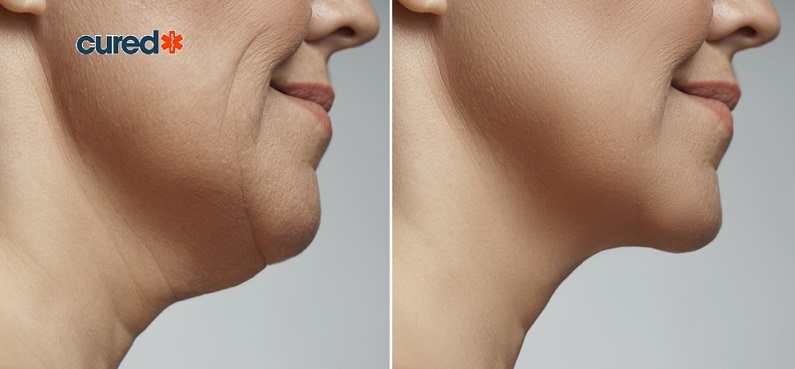 cured  Exercises For A Chiseled Jawline