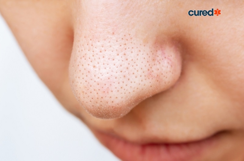 cured blackheads-symptoms-prevention