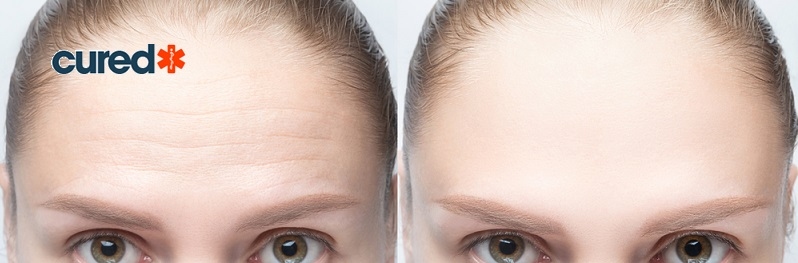 cured forehead treatment