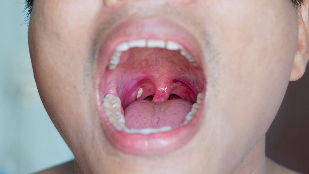 cured Removal Of Tonsil Stones At Home