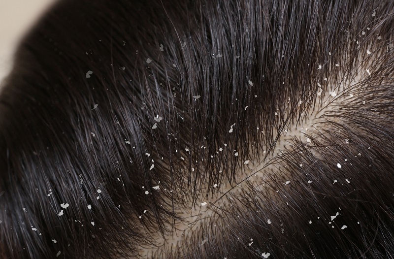 womenwire Best Dandruff Treatments 