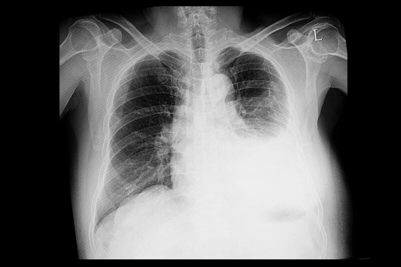 A chest xray of a patient with dyspnea showing large amount of left pleural effusion