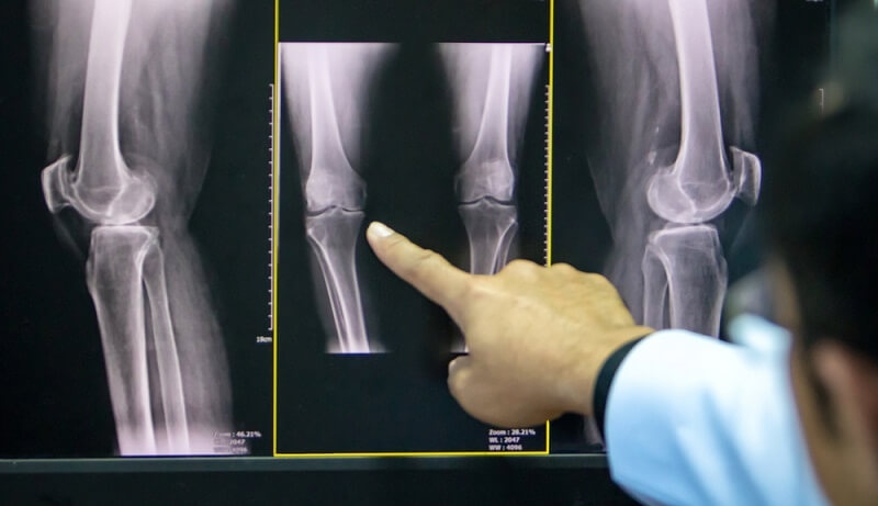 Doctor pointing at the x-ray of knee