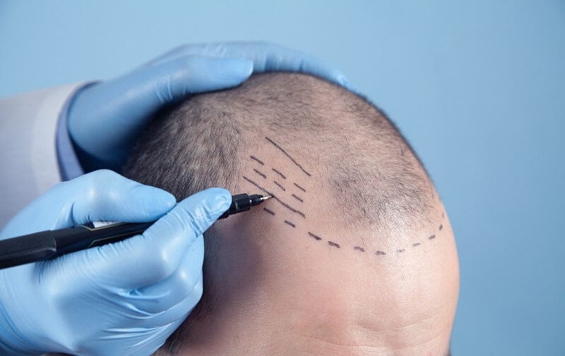 Doctor using skin marker on balding head of a patient