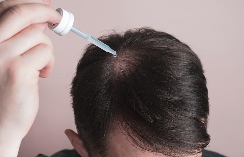 Hair loss problem. Man applying minoxidil on his head with dropper