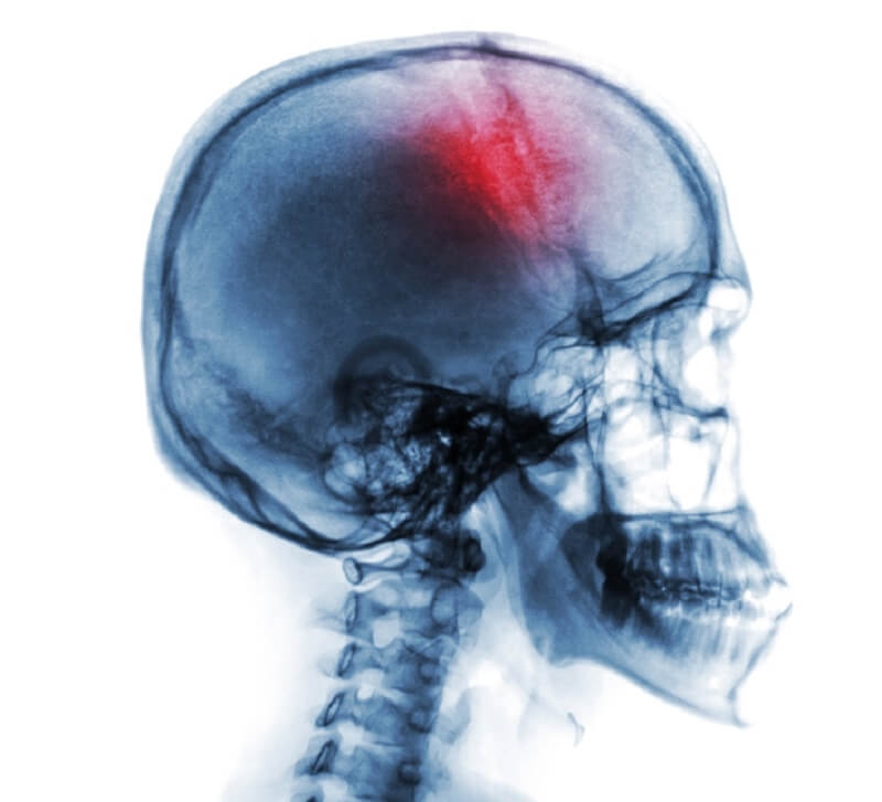 x-ray of human skull showing stroke