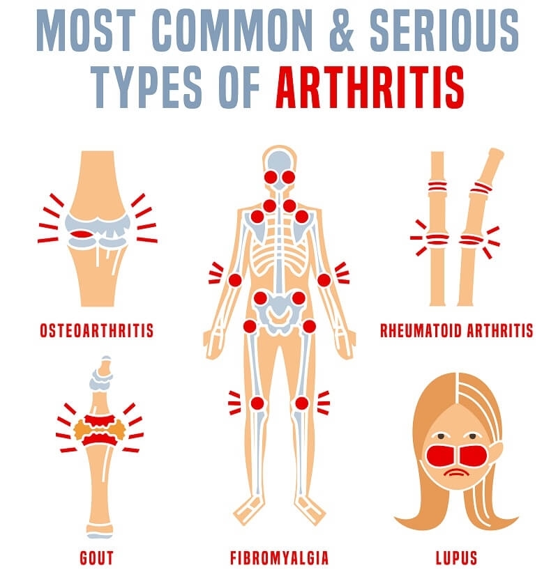 types of arthritis 