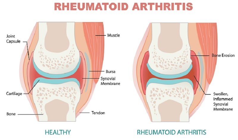 comparison between healthy joint and rheumatoid arthritis