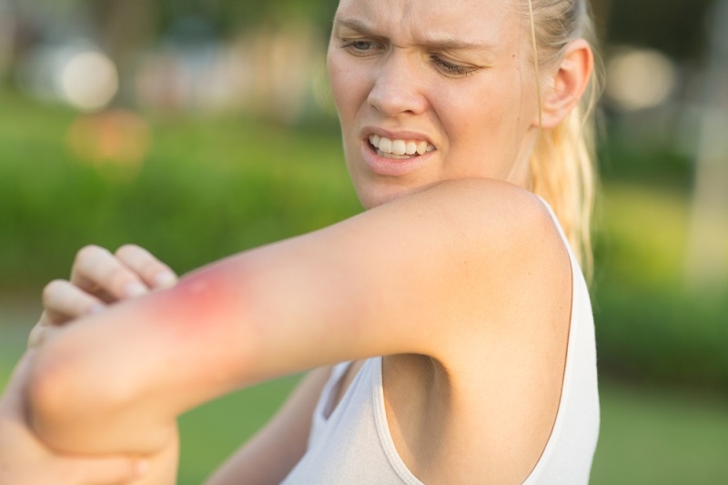 female scratching her itching arm from a bee string