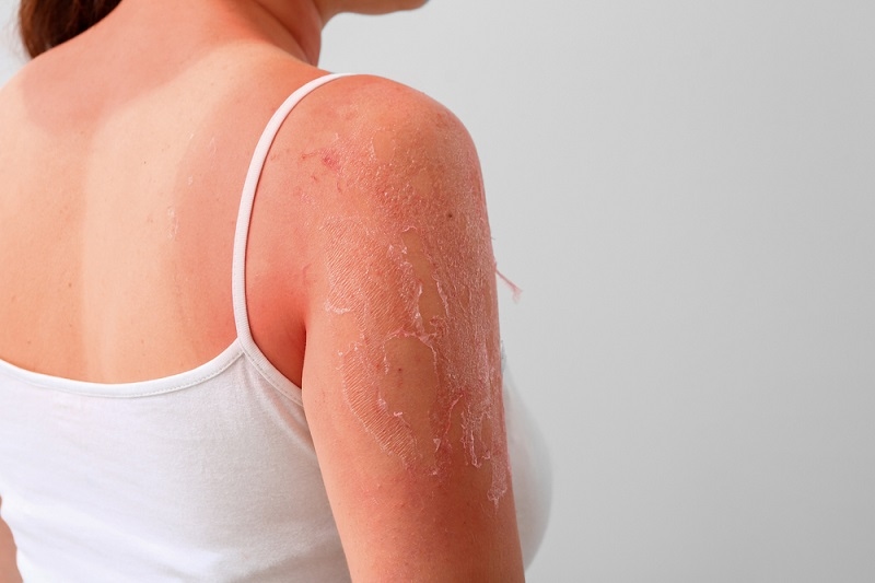 Woman with red sunburned skin