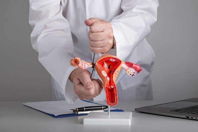 Gynecologist shows how to ligate the fallopian tubes