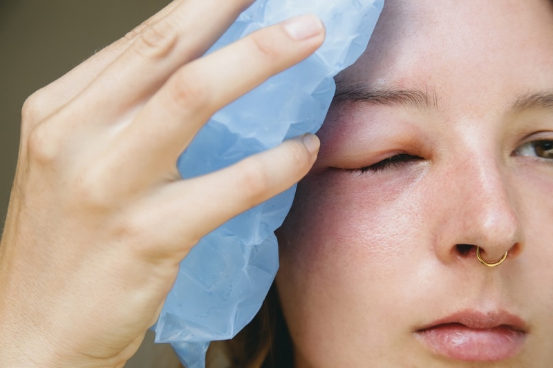 woman with a swollen eye from a bee's sting