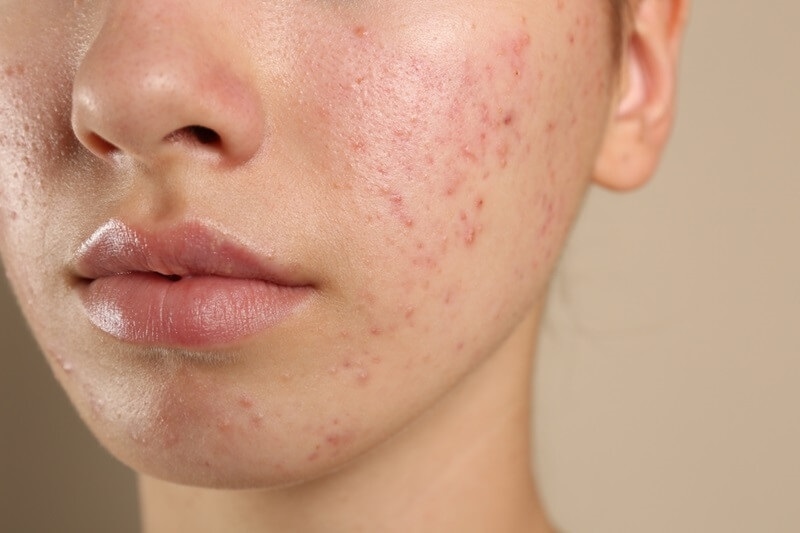 acne-problem-on-face
