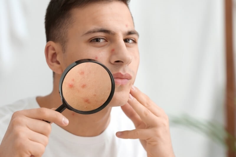acne-treatment-for-men