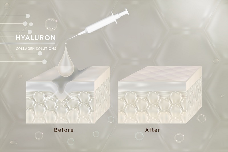 Hyaluronic Acid Is Vital for Anti-Aging Skincare