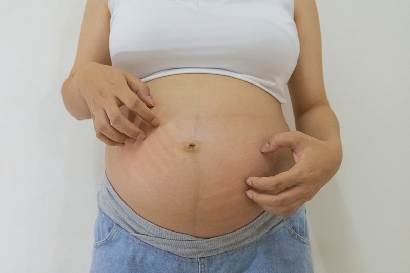 Discover Causes, Symptoms, and Treatments for PUPPP Rash