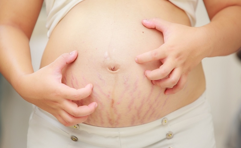Symptoms of PUPPP Rash