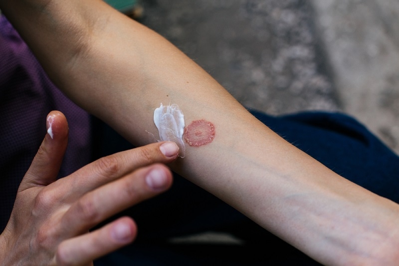 Ringworm Treatment