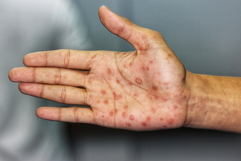 sore hand