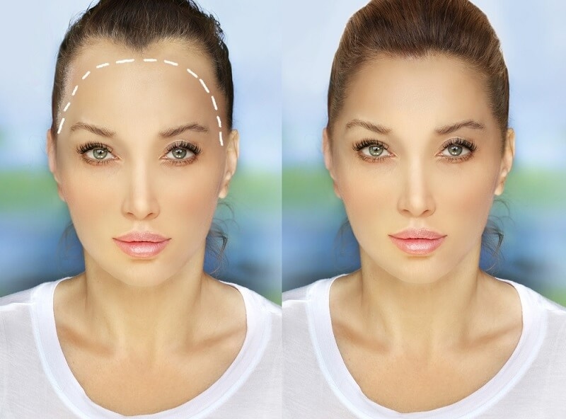 showing result before and after of hairline surgery