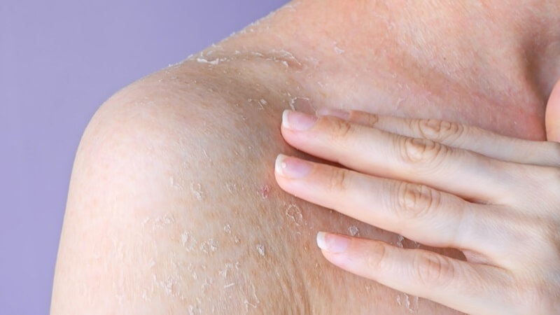 damaged-skin-barrier