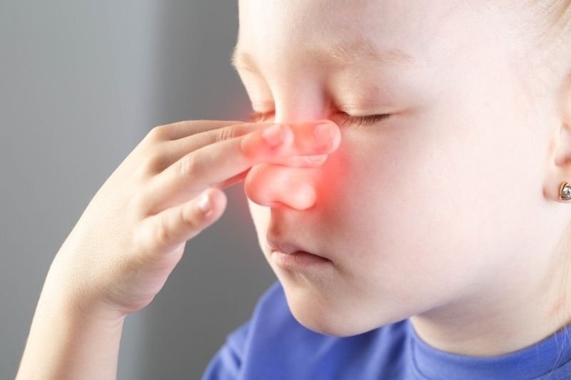 A girl is holding her red nose whose skin is irritated due to a runny nose.
