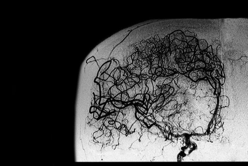 Cerebral angiography image showing a network of blood vessels in the brain.
