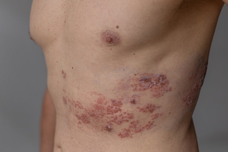 shingles rash