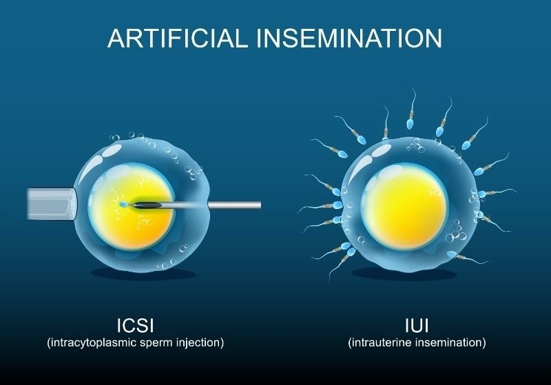 Artificial insemination infographic comparing ICSI and IUI fertility treatments.