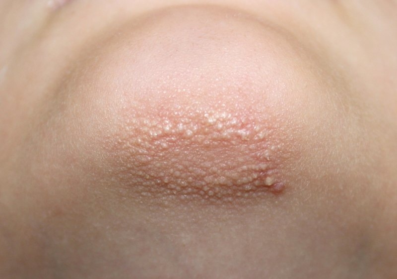 Close-up view of raised, rough bumps and textured skin characteristic of keratosis pilaris.