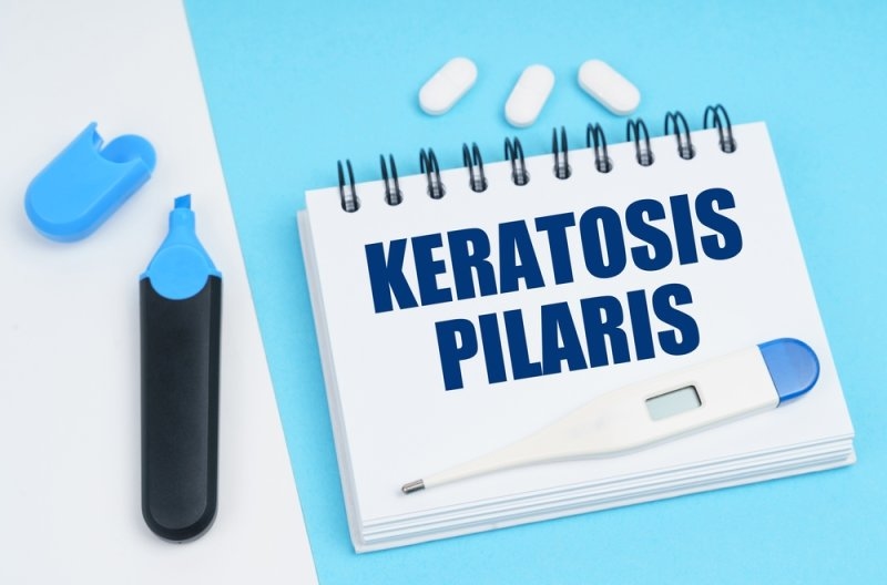 On a white-blue surface are pills, a thermometer, a marker and a notebook with the inscription - KERATOSIS PILARIS.