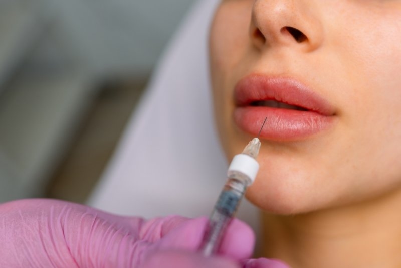 lip filler