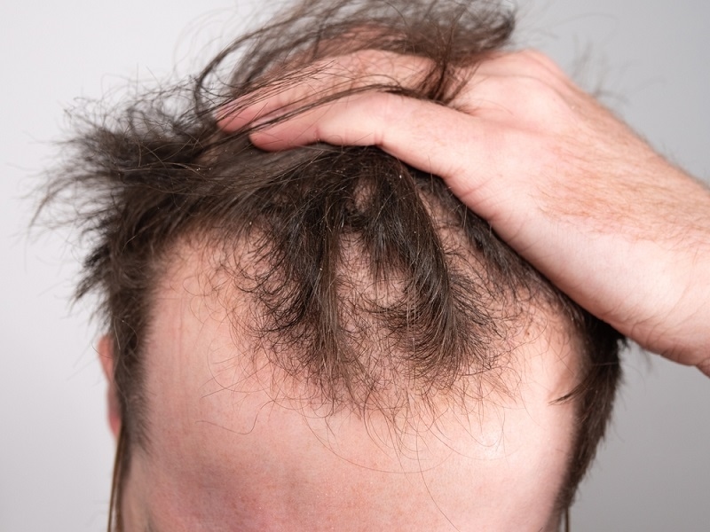 Male Pattern Baldness Stage