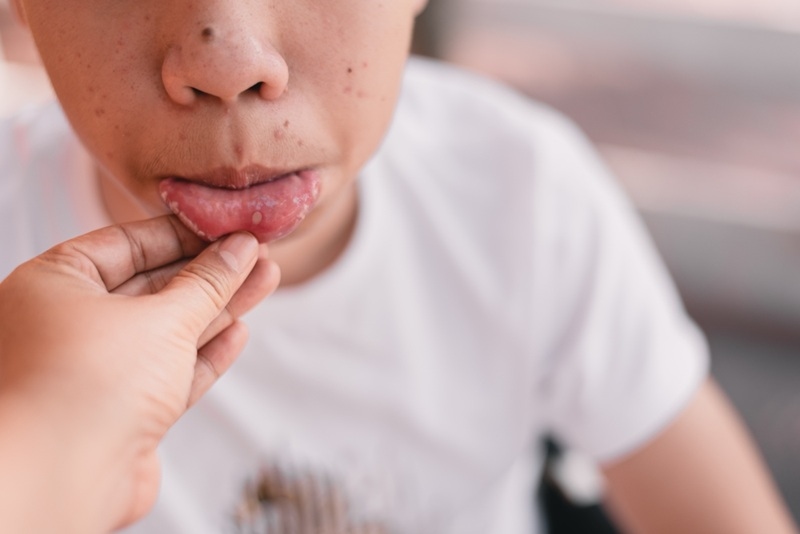 Burning Mouth Syndrome