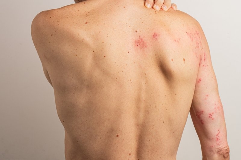 rash caused by shingles in the back
