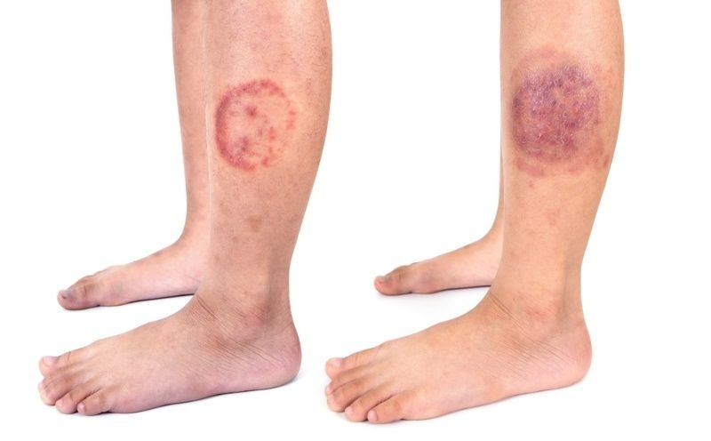 Lower legs showing circular red skin rashes consistent with ringworm infection.