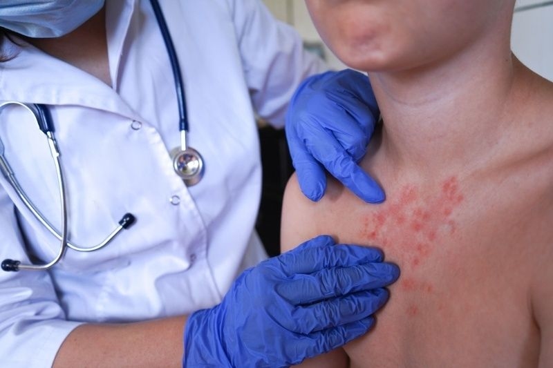 Doctor wearing gloves examining a child’s chest with visible red rash, indicating skin condition.
