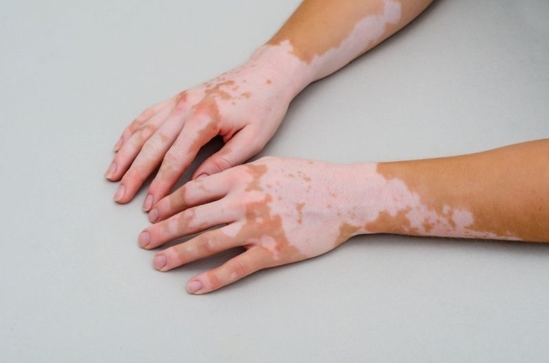 Hands and forearms showing vitiligo with patches of depigmented skin on a neutral background.